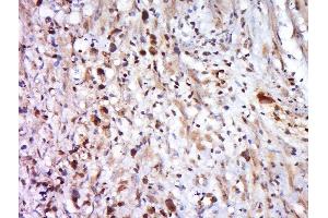 Paraformaldehyde-fixed, paraffin embedded human cervical cancer, Antigen retrieval by boiling in sodium citrate buffer (pH6) for 15min, Block endogenous peroxidase by 3% hydrogen peroxide for 30 minutes, Blocking buffer (normal goat serum) at 37°C for 20min, Antibody incubation with MFAP1 Polyclonal Antibody, Unconjugated  at 1:500 overnight at 4°C, followed by a conjugated secondary and DAB staining (MFAP1 antibody  (AA 31-120))