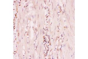 Anti-MRP4 Picoband antibody,  IHC(P): Human Intestinal Cancer Tissue (ABCC4 antibody  (AA 1-370))