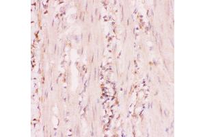 Anti-MRP4 Picoband antibody,  IHC(P): Human Intestinal Cancer Tissue