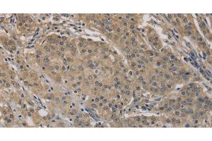 Immunohistochemistry of paraffin-embedded Human gastric cancer tissue using AGTRAP Polyclonal Antibody at dilution 1:40 (AGTRAP antibody)