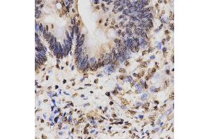 Immunohistochemistry of paraffin-embedded human rectal cancer tissue using H3K27me3 antibody at dilution of 1:200 (x400 lens). (Histone 3 antibody  (H3K27me))