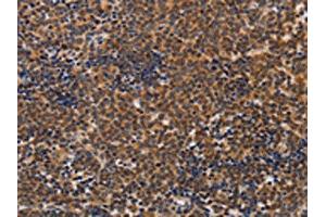 The image on the left is immunohistochemistry of paraffin-embedded Human lymphoma tissue using ABIN7128260(ADH1A Antibody) at dilution 1/20, on the right is treated with fusion protein. (ADH1A antibody)