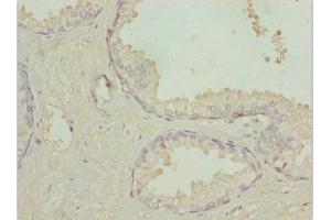 Immunohistochemistry of paraffin-embedded human prostate cancer using ABIN7172947 at dilution of 1:100 (TM9SF1 antibody  (AA 28-230))