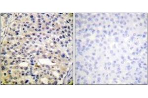 Immunohistochemistry analysis of paraffin-embedded human breast carcinoma, using Vimentin (Phospho-Ser56) Antibody.