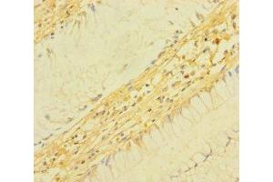 Immunohistochemistry of paraffin-embedded human colon cancer using ABIN7172934 at dilution of 1:100