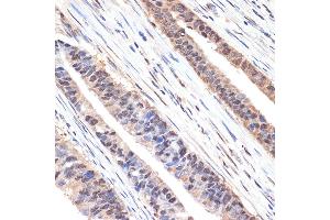 Immunohistochemistry of paraffin-embedded human colon carcinoma using sestrin 1 Rabbit mAb (ABIN7270259) at dilution of 1:100 (40x lens). (SESN1 antibody)