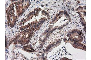 Immunohistochemical staining of paraffin-embedded Adenocarcinoma of Human colon tissue using anti-DSTN mouse monoclonal antibody. (Destrin antibody)