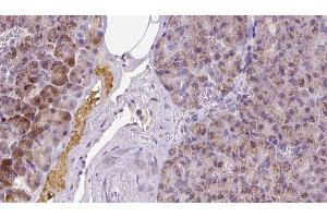 ABIN6273270 at 1/100 staining Human pancreas cancer tissue by IHC-P. (MYH6 antibody  (Internal Region))