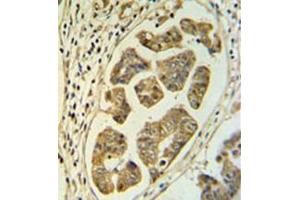 Immunohistochemistry analysis in formalin fixed and paraffin embedded colon carcinoma reacted with HCCS / CCHL Antibody (Center) followed which was peroxidase conjugated to the secondary antibody and followed by DAB staining. (HCCS antibody  (Middle Region))
