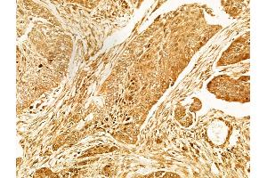 ABIN6263306 and ABIN6266597 at 1/100 staining Human lung cancer by IHC-P.