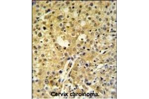 C2orf49 Antibody (N-term) (ABIN651382 and ABIN2840213) IHC analysis in formalin fixed and paraffin embedded human cervix carcinoma followed by peroxidase conjugation of the secondary antibody and DAB staining. (C2orf49 antibody  (N-Term))