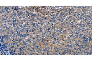 Immunohistochemistry of paraffin-embedded Human cervical cancer using INTS10 Polyclonal Antibody at dilution of 1:50 (INTS10 antibody)