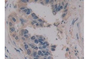 Detection of MPG1 in Human Breast cancer Tissue using Polyclonal Antibody to Macrophage Expressed Gene 1 Protein (MPG1) (MPEG1 antibody  (AA 313-580))