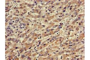 Immunohistochemistry of paraffin-embedded human liver cancer using ABIN7144881 at dilution of 1:100 (ABCA5 antibody  (AA 1230-1355))