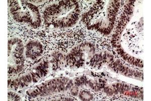 Immunohistochemistry (IHC) analysis of paraffin-embedded Human Colon Cancer, antibody was diluted at 1:100. (p53 antibody  (Internal Region))