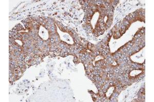IHC-P Image Immunohistochemical analysis of paraffin-embedded human endo mitral ovarian cancer, using CPNE3, antibody at 1:100 dilution. (Copine III antibody)