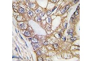 IHC analysis of FFPE human lung carcinoma tissue stained with Ihh antibody (Indian Hedgehog antibody  (AA 1-30))