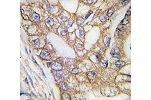 IHC analysis of FFPE human lung carcinoma tissue stained with Ihh antibody (Indian Hedgehog antibody  (AA 1-30))