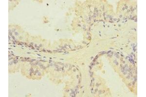 Immunohistochemistry of paraffin-embedded human prostate cancer using ABIN7162859 at dilution of 1:100 (PPIL2 antibody  (AA 1-260))