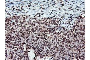 Immunohistochemical staining of paraffin-embedded Adenocarcinoma of Human ovary tissue using anti-TPSG1 mouse monoclonal antibody.