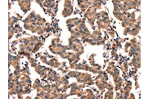 The image on the left is immunohistochemistry of paraffin-embedded Human breast cancer tissue using ABIN7128927(CGA Antibody) at dilution 1/65, on the right is treated with fusion protein. (CGA antibody)