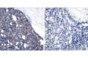 Peptide - +Immunohistochemical analysis of paraffin-embedded human breast carcinoma tissue using IκB-α (Ab-42) antibody (#B7116). (NFKBIA antibody  (Tyr42))