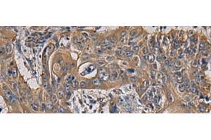 Immunohistochemistry of paraffin-embedded Human esophagus cancer tissue using CCNI Polyclonal Antibody at dilution of 1:65(x200) (Cyclin I antibody)