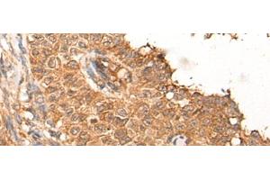 Immunohistochemistry of paraffin-embedded Human ovarian cancer tissue using NRG2 Polyclonal Antibody at dilution of 1:65(x200) (Neuregulin 2 antibody)