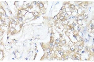 Immunohistochemistry of paraffin-embedded Human liver cancer using SMAD7 Polyclonal Antibody at dilution of 1:100 (40x lens). (SMAD7 antibody)