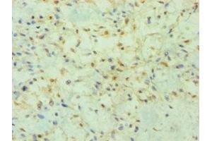 Immunohistochemistry of paraffin-embedded human breast cancer using ABIN7165066 at dilution of 1:100 (PRMT2 antibody  (AA 1-300))