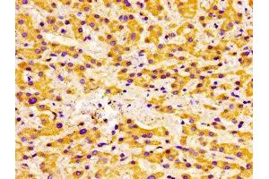 Immunohistochemistry of paraffin-embedded human liver cancer using ABIN7175433 at dilution of 1:100