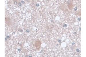 Detection of AST in Human Glioma Tissue using Monoclonal Antibody to Aspartate Aminotransferase (AST) (GOT1 antibody  (AA 1-413))