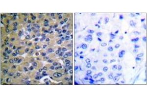 Immunohistochemistry analysis of paraffin-embedded human breast carcinoma, using IkappaB-epsilon (Phospho-Ser22) Antibody. (IkappaB-epsilon antibody  (pSer22))