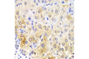Immunohistochemistry of paraffin-embedded human liver cancer using FASN antibody at dilution of 1:100 (400x lens). (Fatty Acid Synthase antibody)
