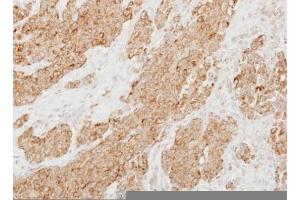 IHC-P Image Immunohistochemical analysis of paraffin-embedded human breast cancer, using Protease Inhibitor 15, antibody at 1:250 dilution. (PI15 antibody  (C-Term))