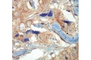 IHC analysis of FFPE human breast carcinoma tissue stained with the FLT3 antibody (FLT3 antibody  (AA 33-64))