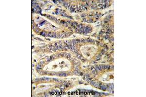 Formalin-fixed and paraffin-embedded human colon carcinoma reacted with IGFBP6 Antibody , which was peroxidase-conjugated to the secondary antibody, followed by DAB staining.