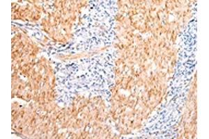 The image on the left is immunohistochemistry of paraffin-embedded Human gastric cancer tissue using ABIN7190483(DMBT1 Antibody) at dilution 1/20, on the right is treated with synthetic peptide. (DMBT1 antibody)