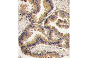 Formalin-fixed and paraffin-embedded human lung carcinoma tissue reacted with Bmp6 antibody (N-term) (ABIN388456 and ABIN2848818) , which was peroxidase-conjugated to the secondary antibody, followed by DAB staining. (BMP6 antibody  (N-Term))