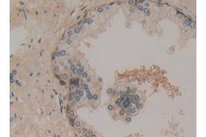 Detection of 0 in Human Prostate Tissue using Polyclonal Antibody to Superoxide Dismutase Copper Chaperone (Superoxide dismutase copper chaperone antibody  (AA 23-269))