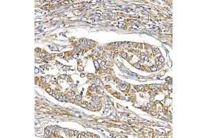 Immunohistochemistry of paraffin-embedded human lung cancer using S Rabbit mAb (ABIN7270501) at dilution of 1:250 (40x lens). (SAMM50 antibody)