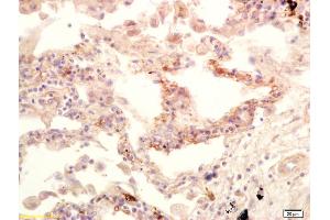 Formalin-fixed and paraffin embedded human lung carcinoma labeled with Anti-GPS1/CSN1 Polyclonal Antibody, Unconjugated (ABIN1385980) at 1:200 followed by conjugation to the secondary antibody and DAB staining.