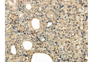 The image on the left is immunohistochemistry of paraffin-embedded Human thyroid cancer tissue using ABIN7128055(UBE2B Antibody) at dilution 1/30, on the right is treated with fusion protein.