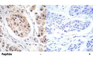 Immunohistochemical analysis of paraffin-embedded human breast carcinoma tissue using FOXO3 (phospho S253) polyclonal antibody . (FOXO3 antibody  (pSer253))