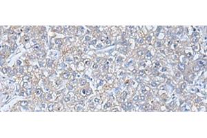 Immunohistochemistry of paraffin-embedded Human liver cancer tissue using TREM1 Polyclonal Antibody at dilution of 1:50(x200) (TREM1 antibody)