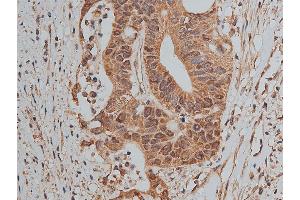 ABIN6268858 at 1/50 staining human colon cancer tissue sections by IHC-P. (MCL-1 antibody  (Internal Region))