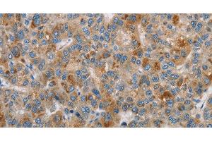 Immunohistochemistry of paraffin-embedded Human liver cancer using DBH Polyclonal Antibody at dilution of 1:70 (DBH antibody)