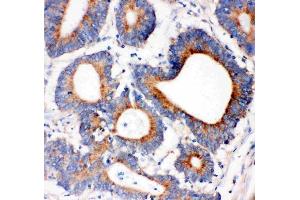 Anti-IRS1 antibody, (ABIN3043251), IHC(P)IHC(P): Human Intestinal Cancer Tissue (IRS1 antibody  (AA 1041-1242))
