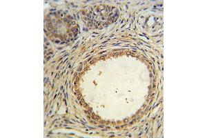 AMH Antibody IHC analysis in formalin fixed and paraffin embedded prostate carcinoma followed by peroxidase conjugation of the secondary antibody and DAB staining. (AMH antibody  (AA 424-451))