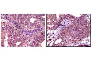 Immunohistochemical analysis of paraffin-embedded human ovary carcinoma (left) and breast carcinoma (right), showing cytoplasmic localization using EphA1 mouse mAb with DAB staining. (EPHA1 antibody)